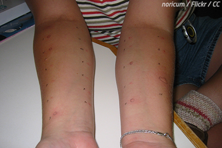 Allergy skin test